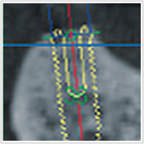 インプラント断面図